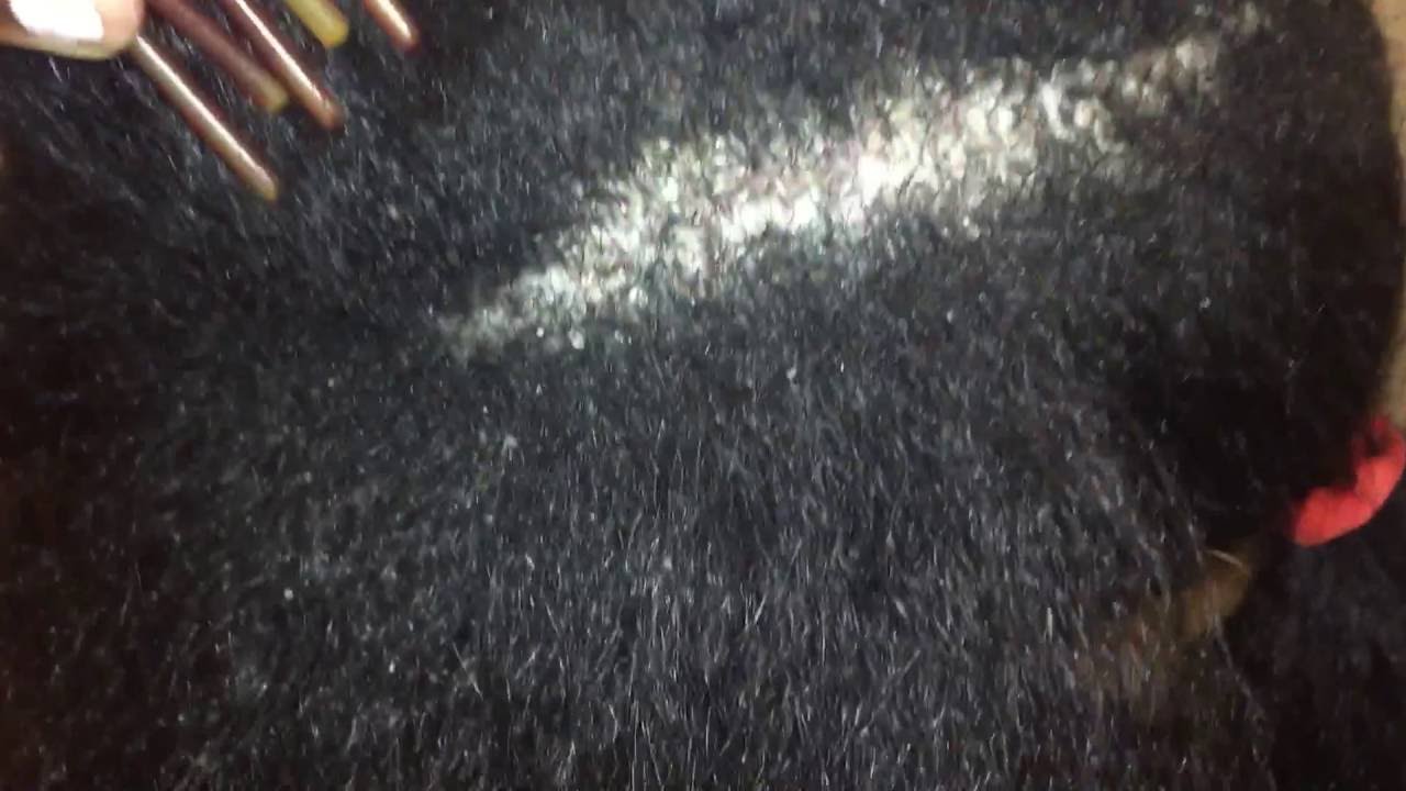 dandruff